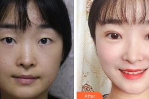 中国人民解放军总政门诊部医学美容中心王世勇整形价格表附切开双眼皮案例展示