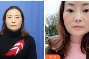 中国人民解放军第四五七医院陆海整形价格表附激光去眼袋案例展示