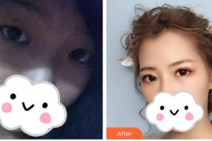 解放军四五四医院整形美容中心周吉玲整形价格表附眼部综合案例展示