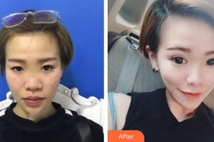 解放军总装备部后勤部医学整形中心陈比较好的整形价格表附眼部综合案例展示