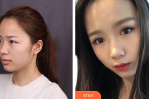 解放军总装备部后勤部医学整形中心张卫东整形价格表附眼部综合案例展示