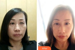 解放军四五四医院整形美容中心严道金整形价格表附热拉提案例展示