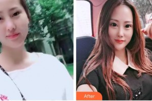 解放军421医院整形美容中心刘春利整形价格表附热拉提案例展示