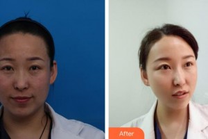 解放军421医院整形美容中心潘晓海整形价格表抗衰老紧肤埋线提升案例展示