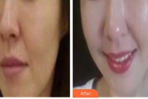 解放军422医院医学整形美容中心查选平整形价格表附埋线提升案例展示