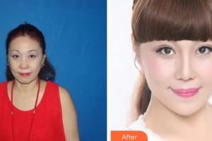 解放军总装备部后勤部医学整形中心钟华整形价格表附埋线提升案例展示