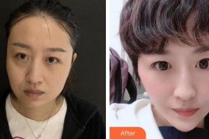 解放军421医院整形美容中心李新莉整形价格表附埋线提升案例展示