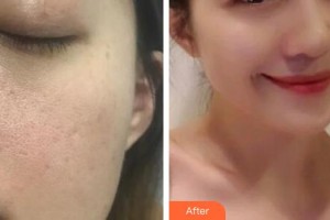 解放军总医院第一附属医院烧伤整形科梁黎明整形价格表附埋线提升案例展示