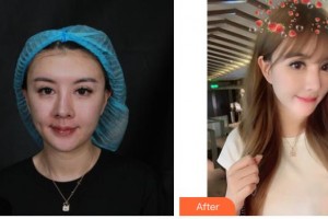 解放军307医院整形烧伤科杨志祥整形价格表附埋线提升案例展示