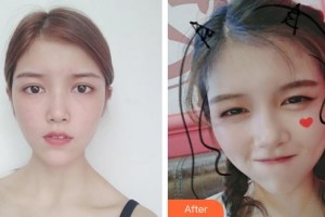 解放军总医院第一附属医院烧伤整形科许明火整形价格表附热玛吉案例展示