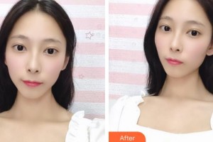 解放军422医院医学整形美容中心郑圣谟整形价格表附埋线提升案例展示