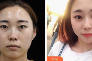 解放军421医院整形美容中心赵莉整形价格表附埋线提升案例展示