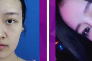 解放军总医院第一附属医院烧伤整形科贾赤宇整形价格表附鼻部综合案例展示