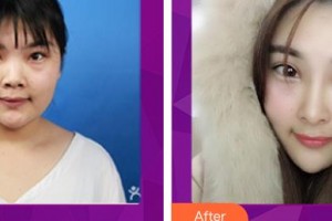 解放军总医院第一附属医院烧伤整形科李利根整形价格表附鼻部综合案例展示