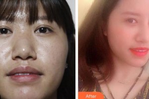 解放军总医院第一附属医院烧伤整形科杨红明整形价格表附鼻部综合案例展示