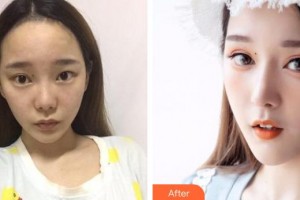 解放军总医院第一附属医院烧伤整形科宋慧锋整形价格表附假体隆鼻案例展示