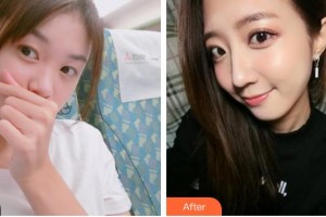 解放军总医院第一附属医院烧伤整形科陈宝驹整形价格表附鼻部综合案例展示