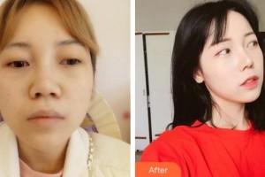 解放军总医院第一附属医院烧伤整形科郭振荣整形价格表附假体隆鼻案例展示