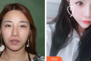 解放军第三〇三医院烧伤整形美容外科杨家骥整形价格表附鼻部综合案例展示