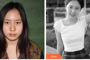 解放军第三〇三医院烧伤整形美容外科黄震亚整形价格表附鼻部综合案例展示