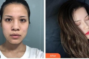 解放军第三〇三医院烧伤整形美容外科黄卓正整形价格表附鼻部综合案例展示