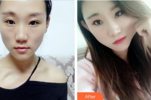 解放军总医院第一附属医院烧伤整形科申传安整形价格表附硅胶隆鼻案例展示