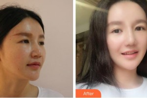 中国人民解放军第一六三医院整形美容中心刘丽芳整形价格表附假体隆鼻案例展示