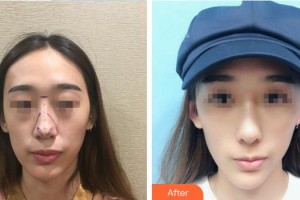 中国人民解放军251医院整形美容科全娟整形价格表附鼻部综合案例展示