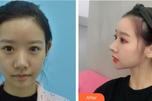 中国人民解放军251医院整形美容科阮仕荣整形价格表附鼻部综合案例展示