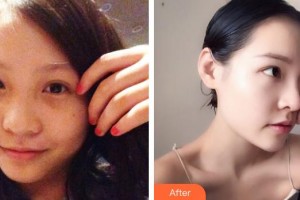 中国人民解放军第一六三医院整形美容中心董海燕整形价格表附鼻部综合案例展示