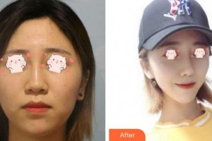 解放军第159医院烧伤整形美容康复中心林国安整形价格表附鼻部综合案例展示