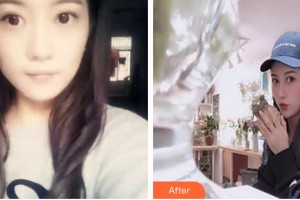 中国人民解放军251医院整形美容科张瑾整形价格表附假体隆鼻案例展示