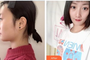 解放军总医院第一附属医院烧伤整形科朱兆明整形价格表附假体隆鼻案例展示