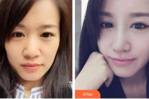 中国人民解放军第一六三医院整形美容中心吴丙整形价格表附硅胶隆鼻案例展示