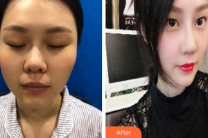 解放军第159医院烧伤整形美容康复中心袁仕安整形价格表附肋软骨隆鼻案例展示