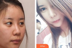 中国人民解放军第一六三医院整形美容中心易文林整形价格表附膨体隆鼻案例展示