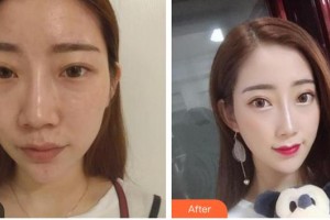 中国人民解放军第五十九中心医院烧伤整形科潘文东整形价格表附膨体隆鼻案例展示