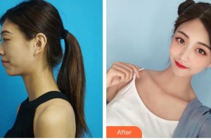 解放军474医院激光美容中心闫霜整形价格表附耳软骨复合隆鼻案例展示