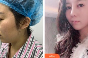 解放军474医院激光美容中心李红整形价格表附鼻翼缩小案例展示