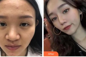 解放军105医院整形美容中心贾亮整形价格表附鼻部综合案例展示