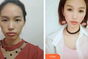 解放军一八一医院医学整形美容科朱赛玲整形价格表附鼻部综合案例展示