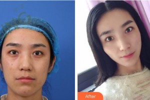 解放军第159医院烧伤整形美容康复中心杨晓东整形价格表附埋线提升案例展示