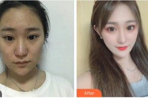 解放军105医院整形美容中心卫侠整形价格表附激光美肤激光案例展示