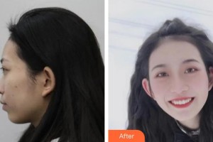 中国人民解放军第100医院整形美容中心武晓莉整形价格表附埋线提升案例展示