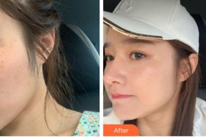 解放军一八一医院医学整形美容科粟雪梅整形价格表附激光美肤激光案例展示