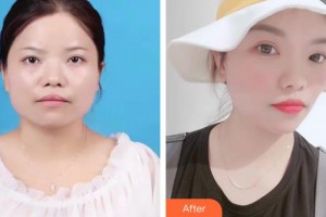 中国人民解放军第100医院整形美容中心孙守县整形价格表附埋线提升案例展示