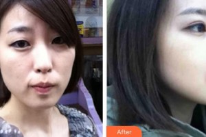 中国人民解放军第100医院整形美容中心韩小菊整形价格表附埋线提升案例展示