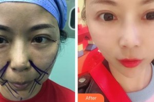 中国人民解放军第455疤痕调节中心钟晓珊整形价格表附埋线提升案例展示