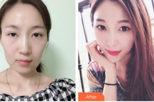 中国人民解放军第100医院整形美容中心陈舒整形价格表附热玛吉案例展示