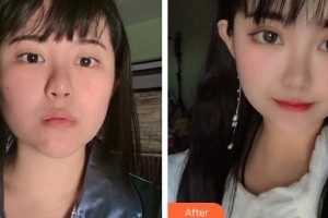 第四军医大学唐都医院整形激光美容中心陈绍宗整形价格表附鼻翼缩小案例展示